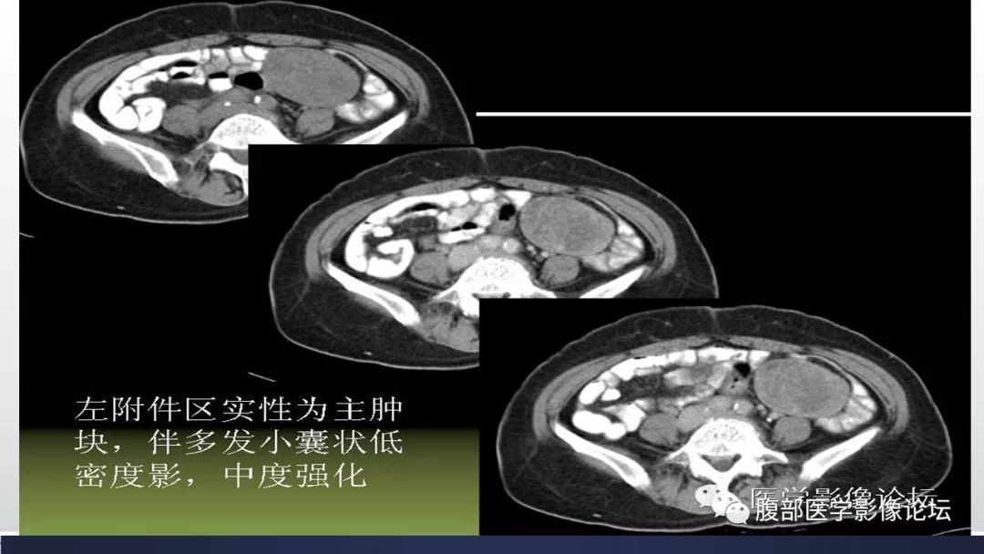 【病例】卵巢黄素化卵泡膜细胞瘤1例CT影像