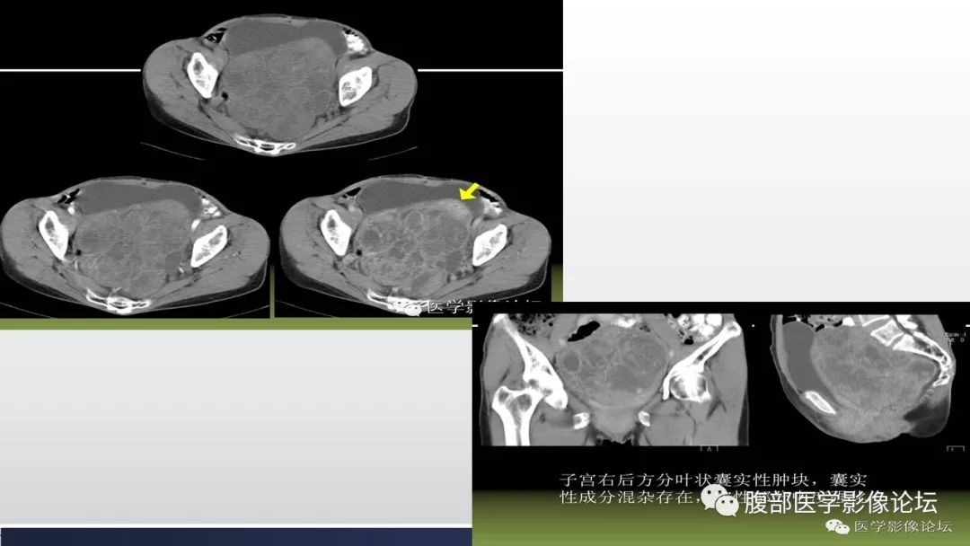 【病例】卵巢黄素化卵泡膜细胞瘤1例CT影像