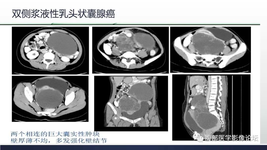 【病例】卵巢黄素化卵泡膜细胞瘤1例CT影像