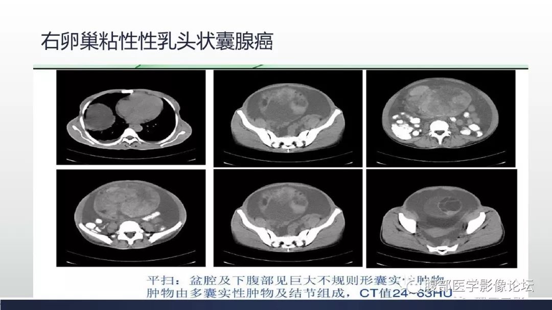 【病例】卵巢黄素化卵泡膜细胞瘤1例CT影像
