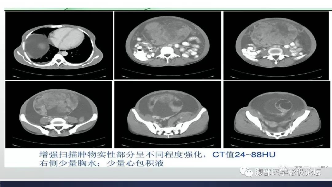 【病例】卵巢黄素化卵泡膜细胞瘤1例CT影像