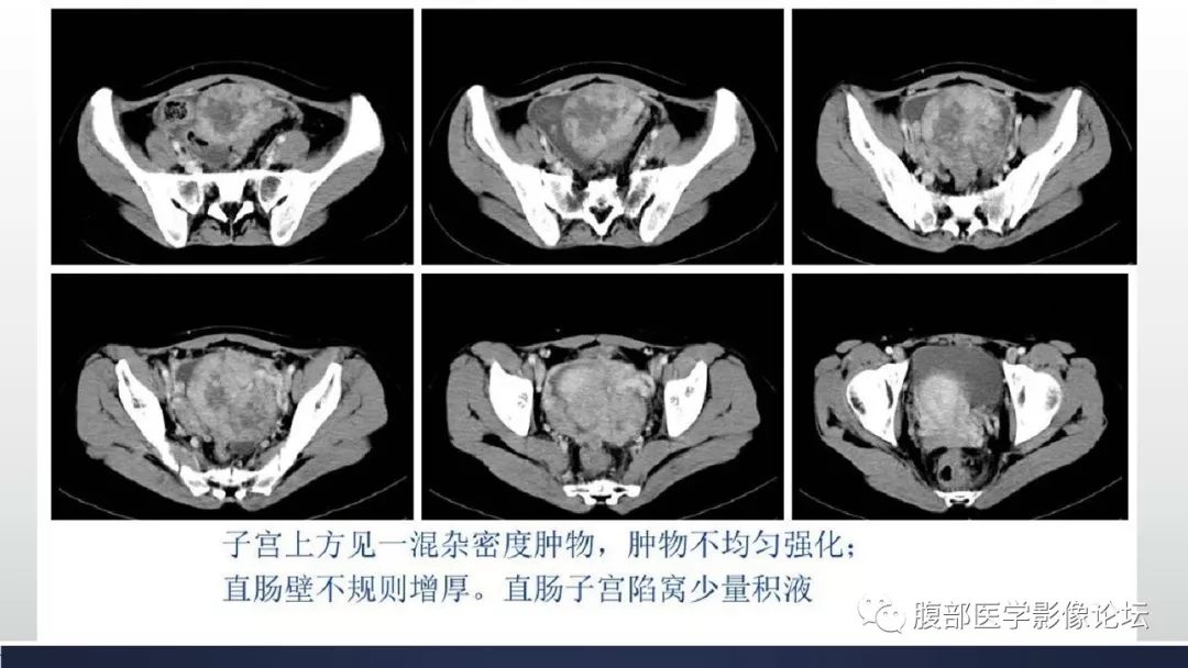 【病例】卵巢黄素化卵泡膜细胞瘤1例CT影像