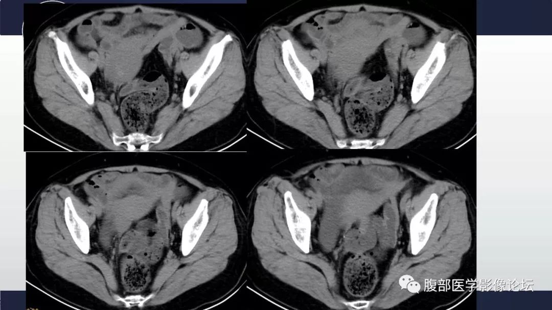【病例】小肠间质瘤1例CT影像