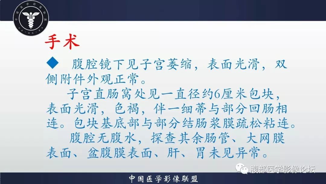 【病例】小肠间质瘤1例CT影像