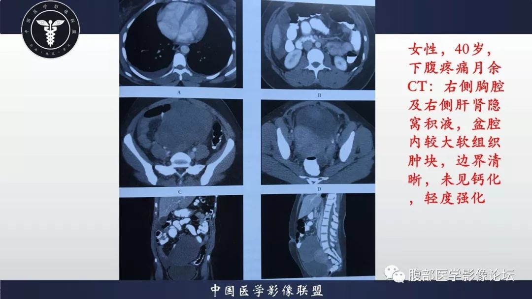 【病例】小肠间质瘤1例CT影像