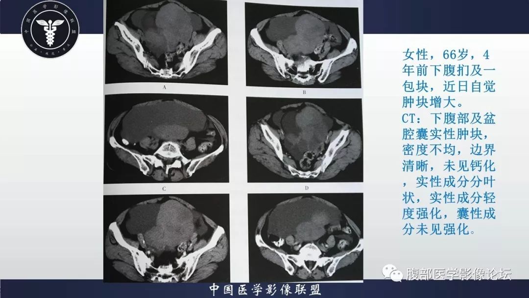 【病例】小肠间质瘤1例CT影像