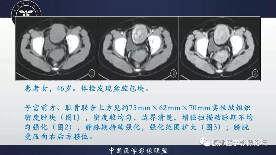 【病例】小肠间质瘤1例CT影像