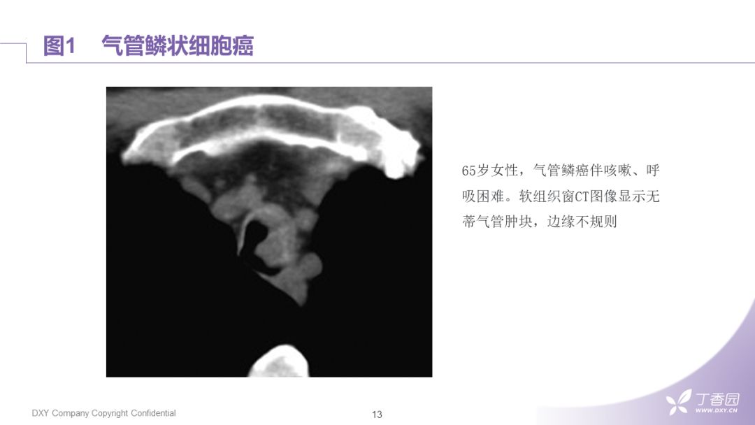 【PPT】大气道肿瘤及肿瘤样病变