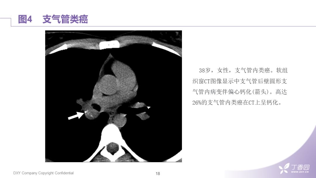 【PPT】大气道肿瘤及肿瘤样病变