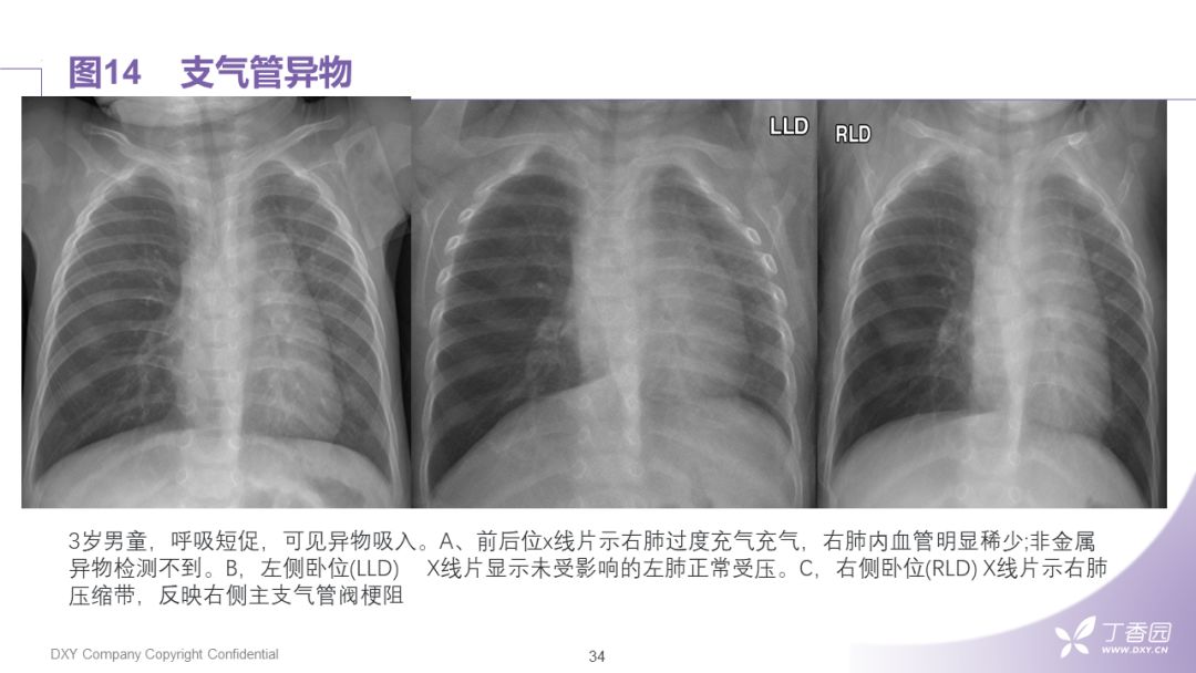 【PPT】大气道肿瘤及肿瘤样病变