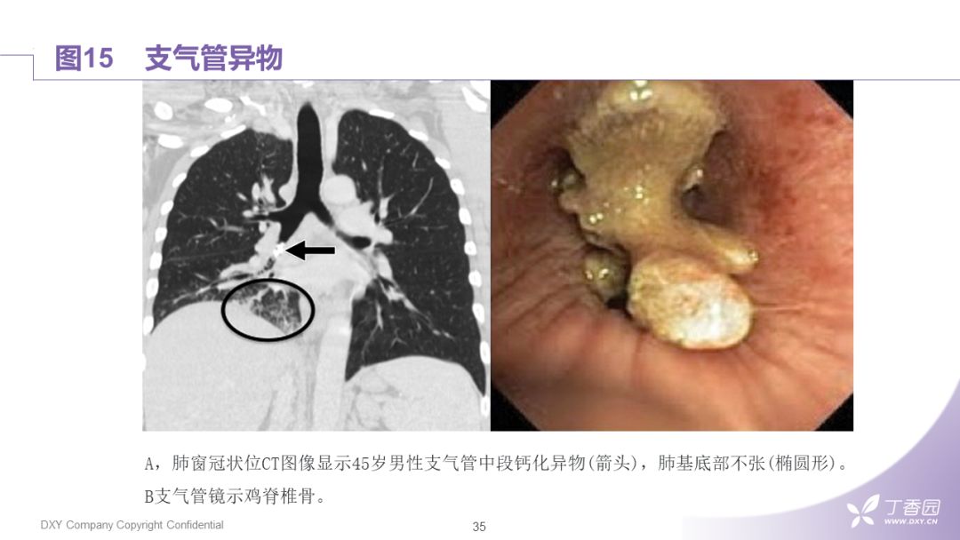 【PPT】大气道肿瘤及肿瘤样病变