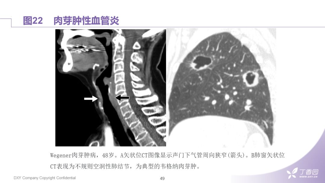 【PPT】大气道肿瘤及肿瘤样病变
