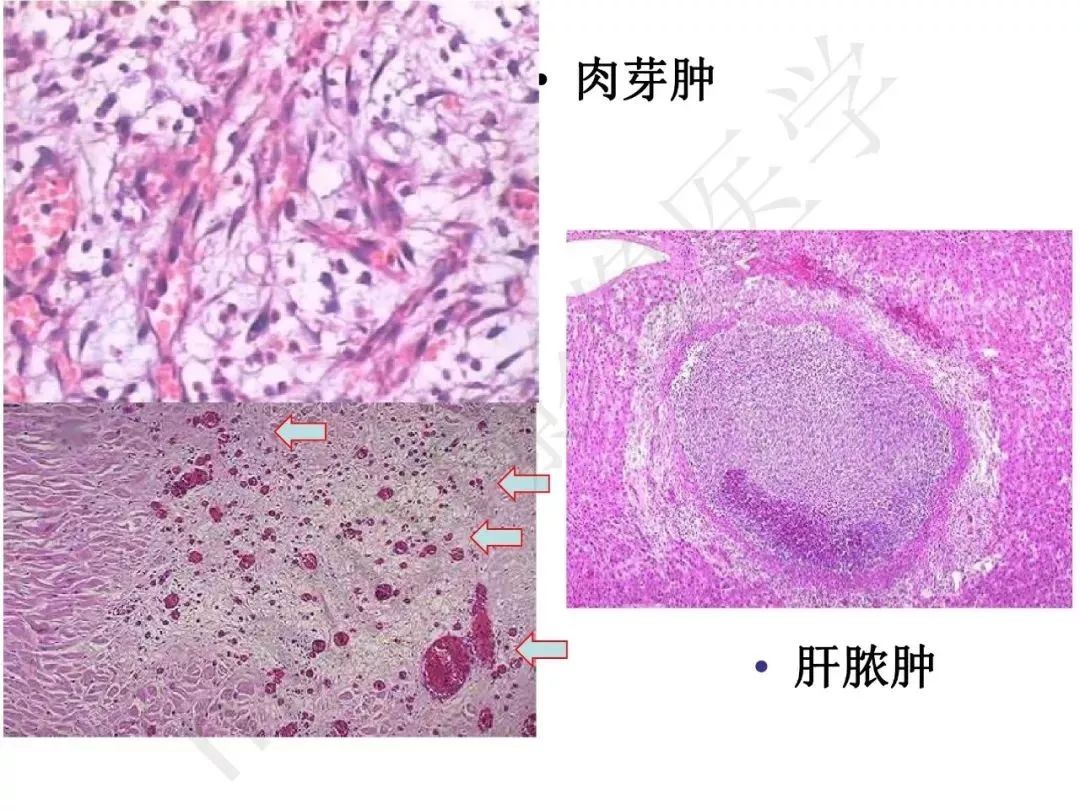 【PPT】纤维组织在肝脏炎性病变MR诊断中的价值