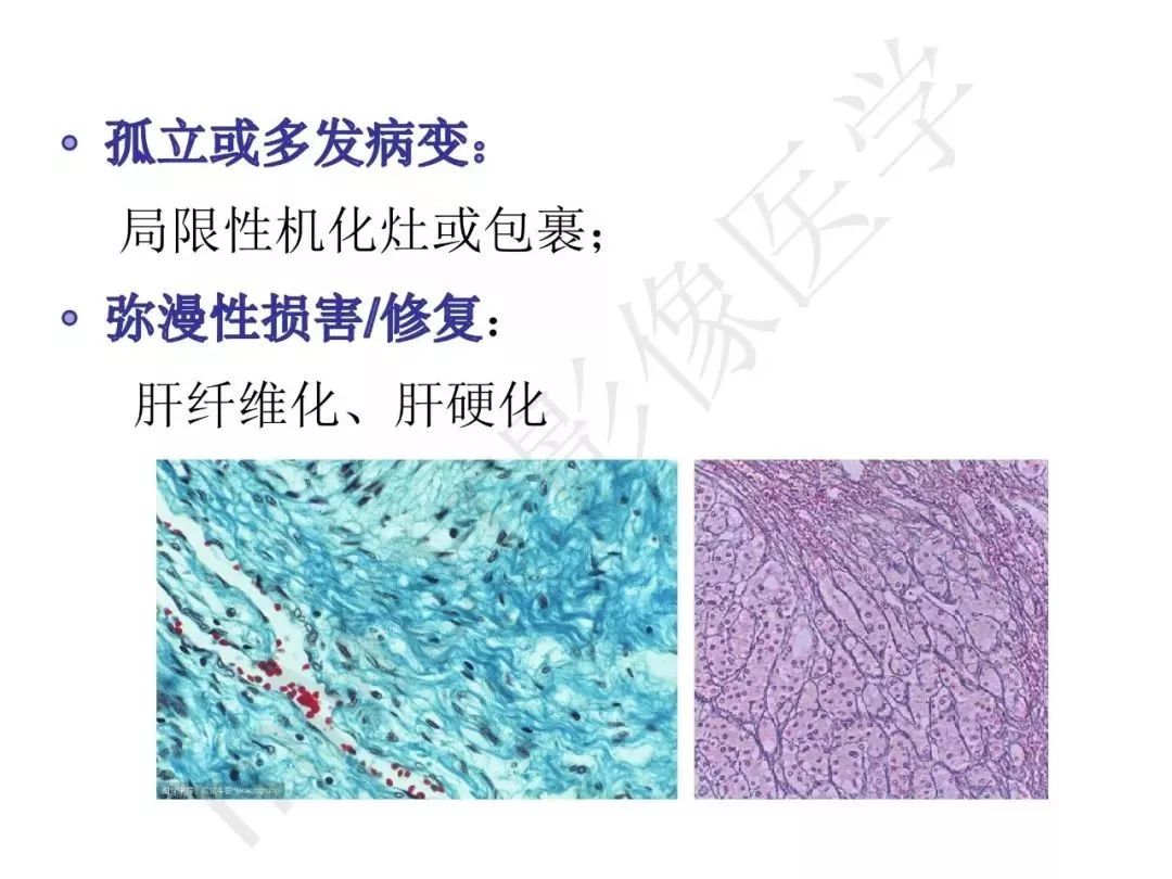 【PPT】纤维组织在肝脏炎性病变MR诊断中的价值