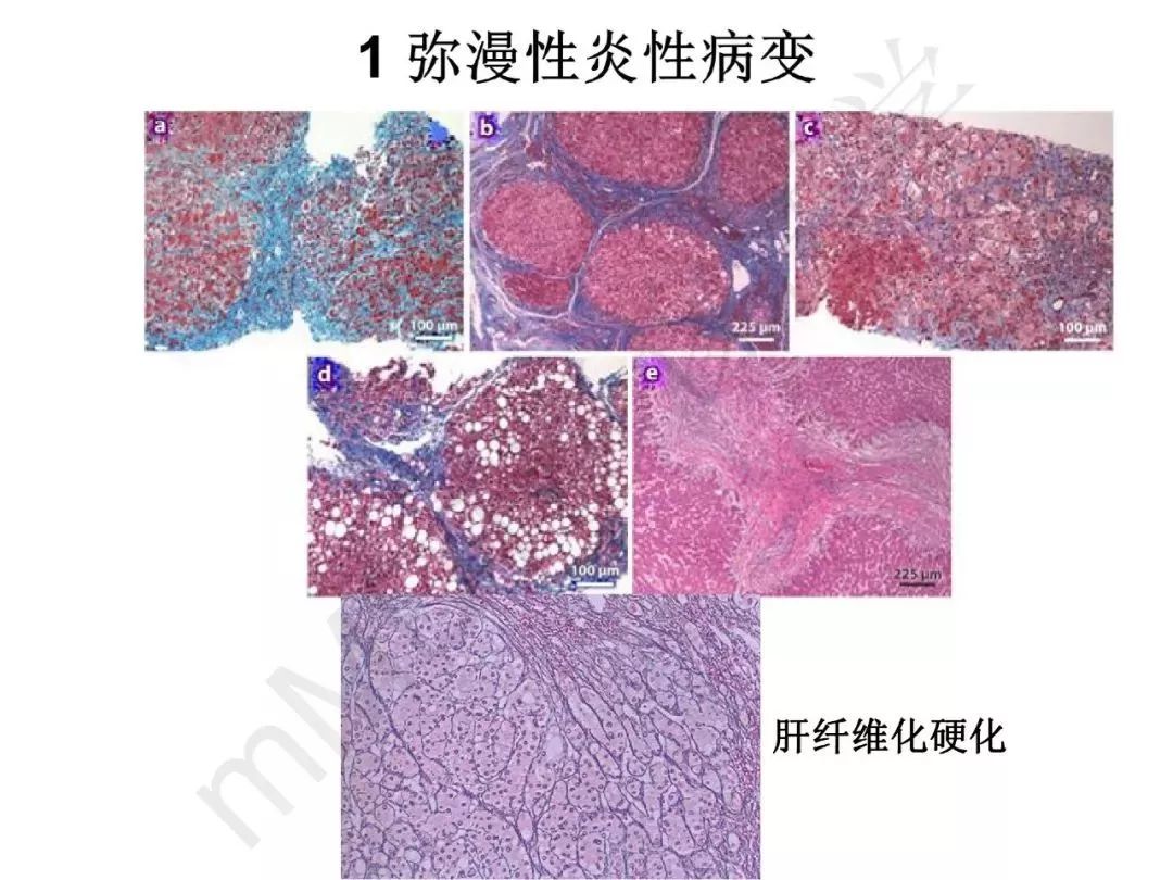 【PPT】纤维组织在肝脏炎性病变MR诊断中的价值