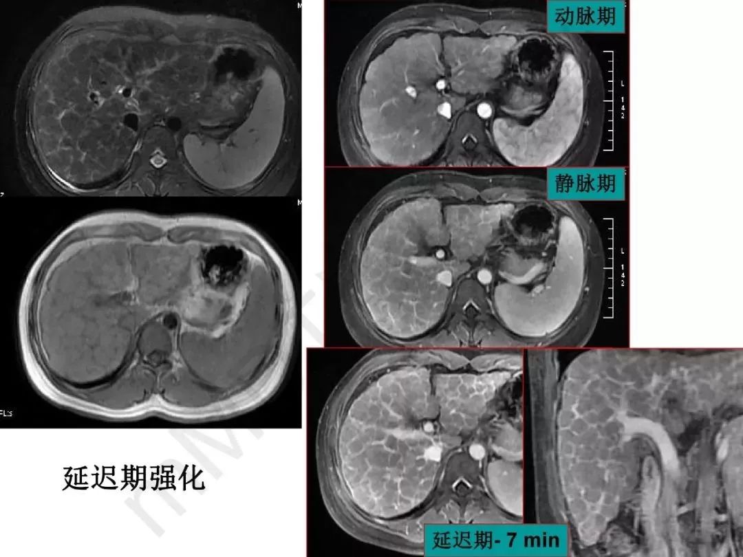 【PPT】纤维组织在肝脏炎性病变MR诊断中的价值