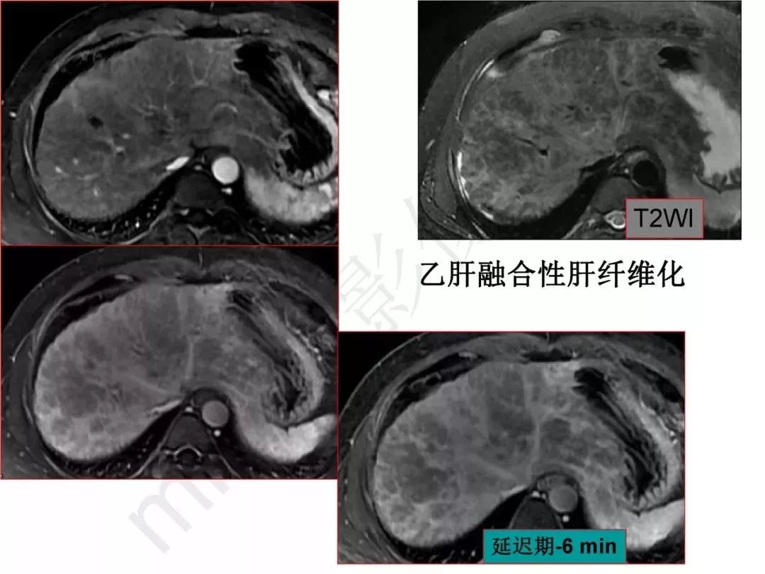 【PPT】纤维组织在肝脏炎性病变MR诊断中的价值