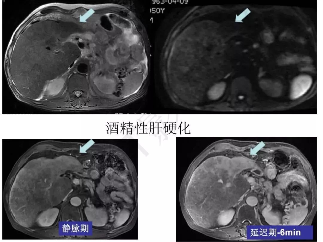 【PPT】纤维组织在肝脏炎性病变MR诊断中的价值