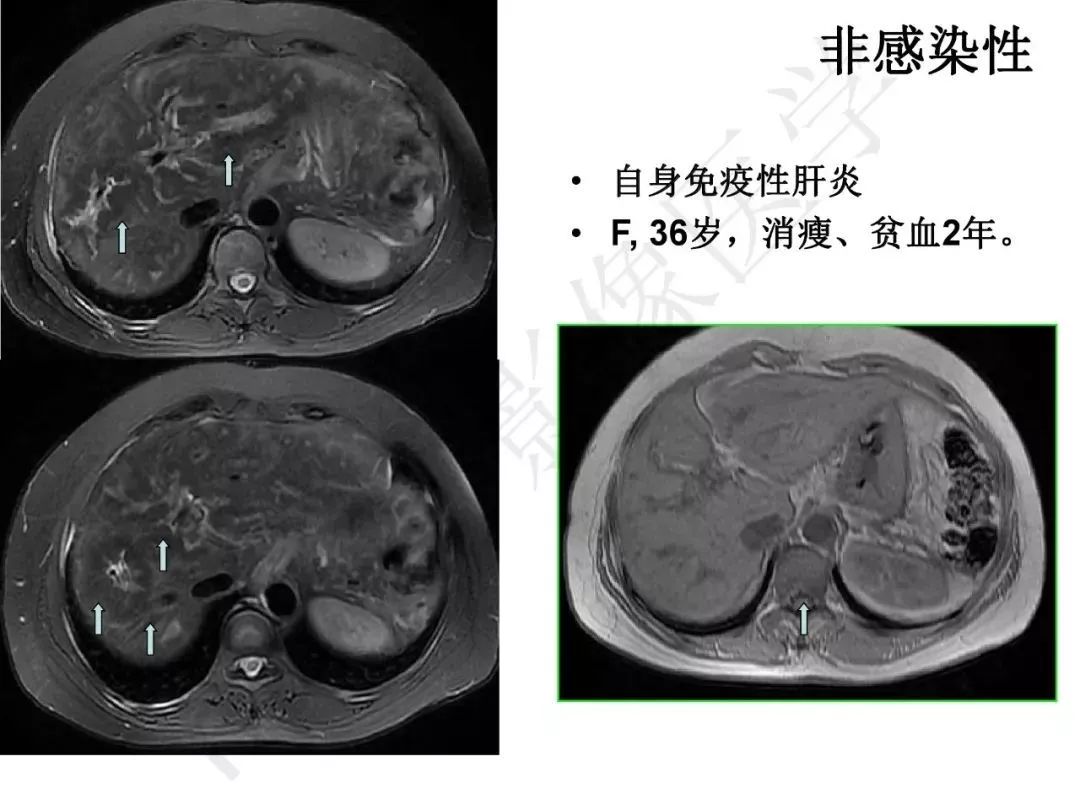 【PPT】纤维组织在肝脏炎性病变MR诊断中的价值