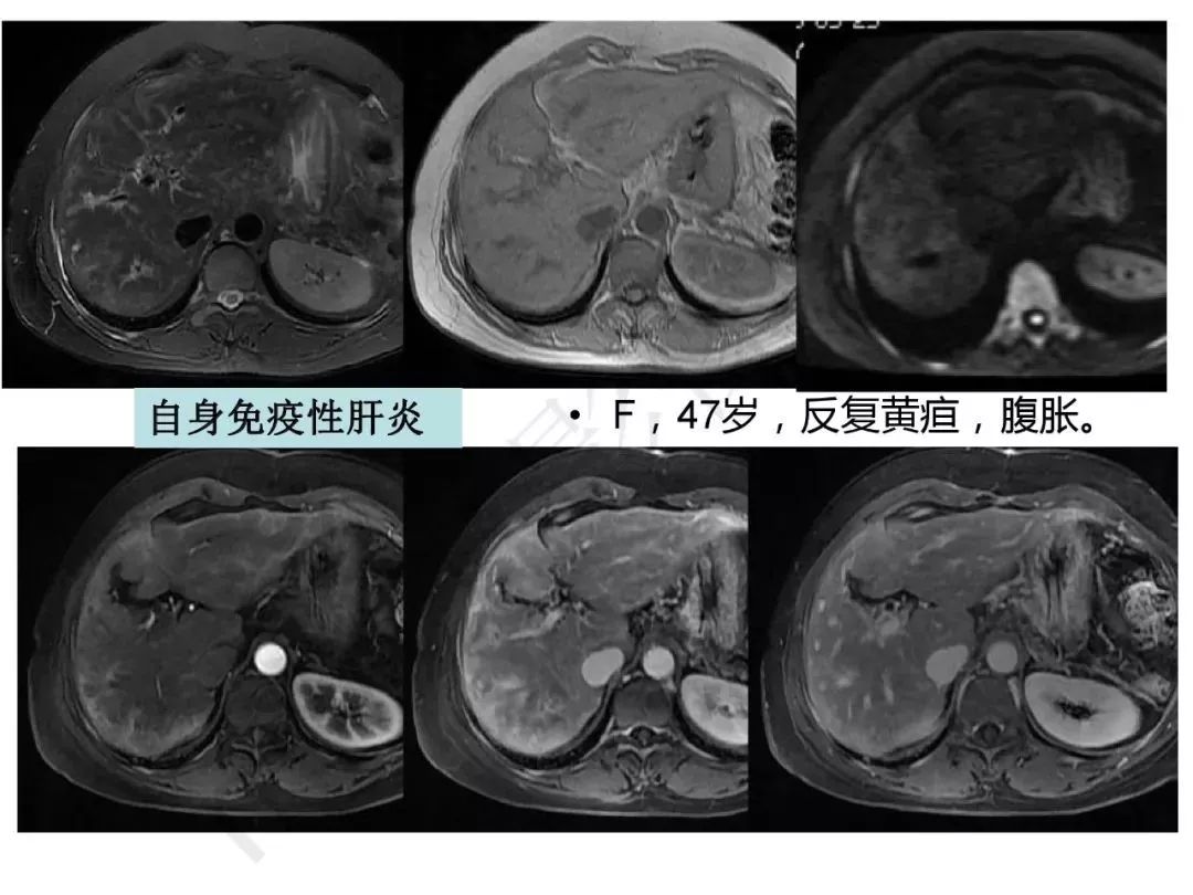 【PPT】纤维组织在肝脏炎性病变MR诊断中的价值
