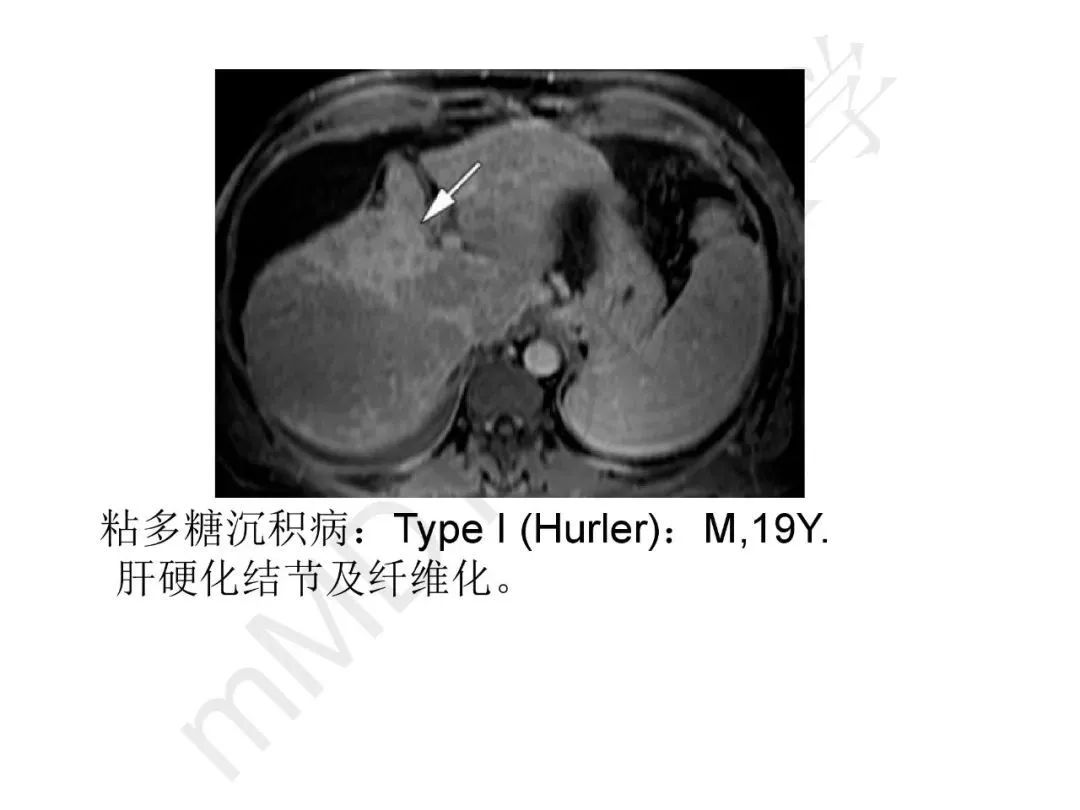 【PPT】纤维组织在肝脏炎性病变MR诊断中的价值
