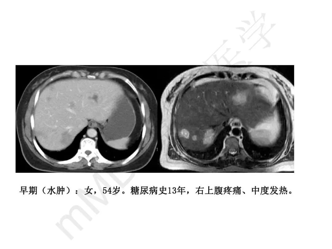 【PPT】纤维组织在肝脏炎性病变MR诊断中的价值