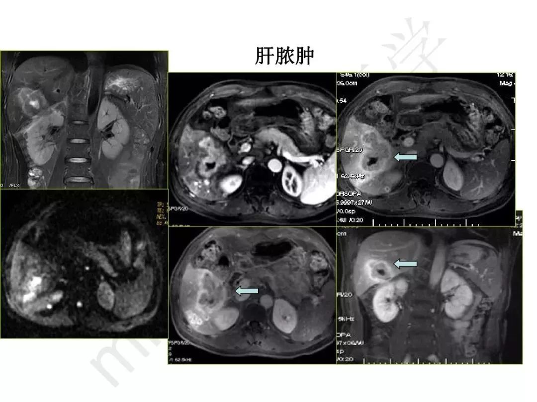 【PPT】纤维组织在肝脏炎性病变MR诊断中的价值