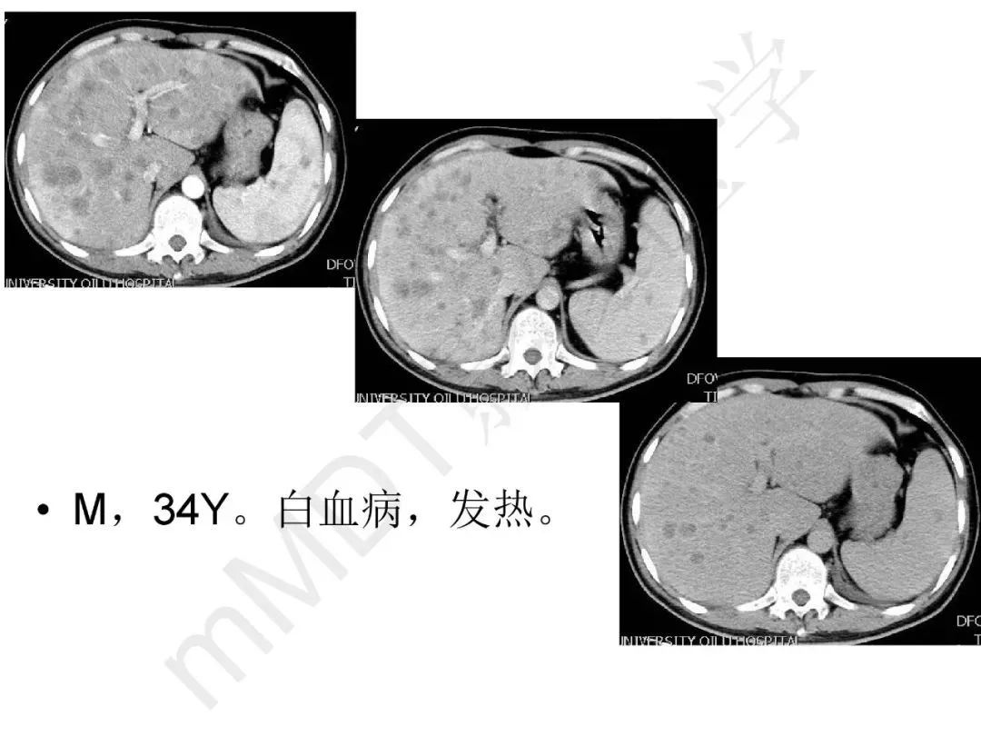 【PPT】纤维组织在肝脏炎性病变MR诊断中的价值