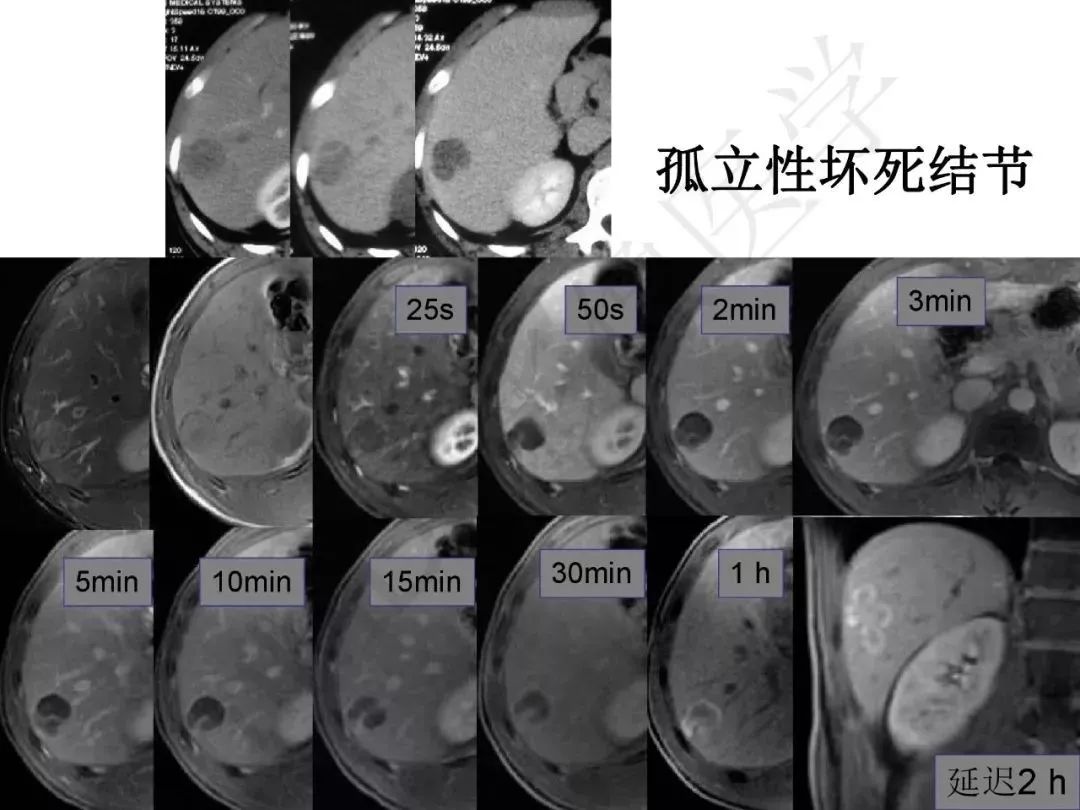 【PPT】纤维组织在肝脏炎性病变MR诊断中的价值