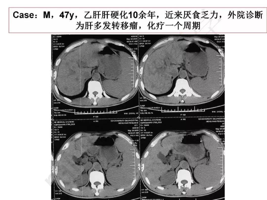 【PPT】纤维组织在肝脏炎性病变MR诊断中的价值