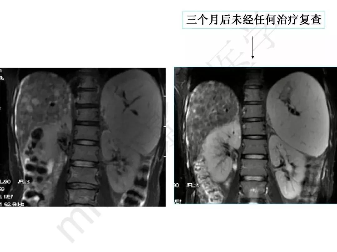 【PPT】纤维组织在肝脏炎性病变MR诊断中的价值
