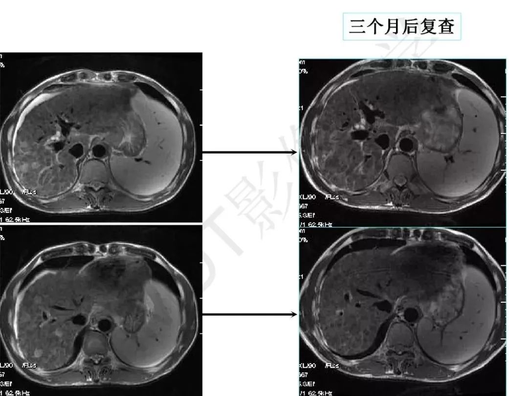 【PPT】纤维组织在肝脏炎性病变MR诊断中的价值