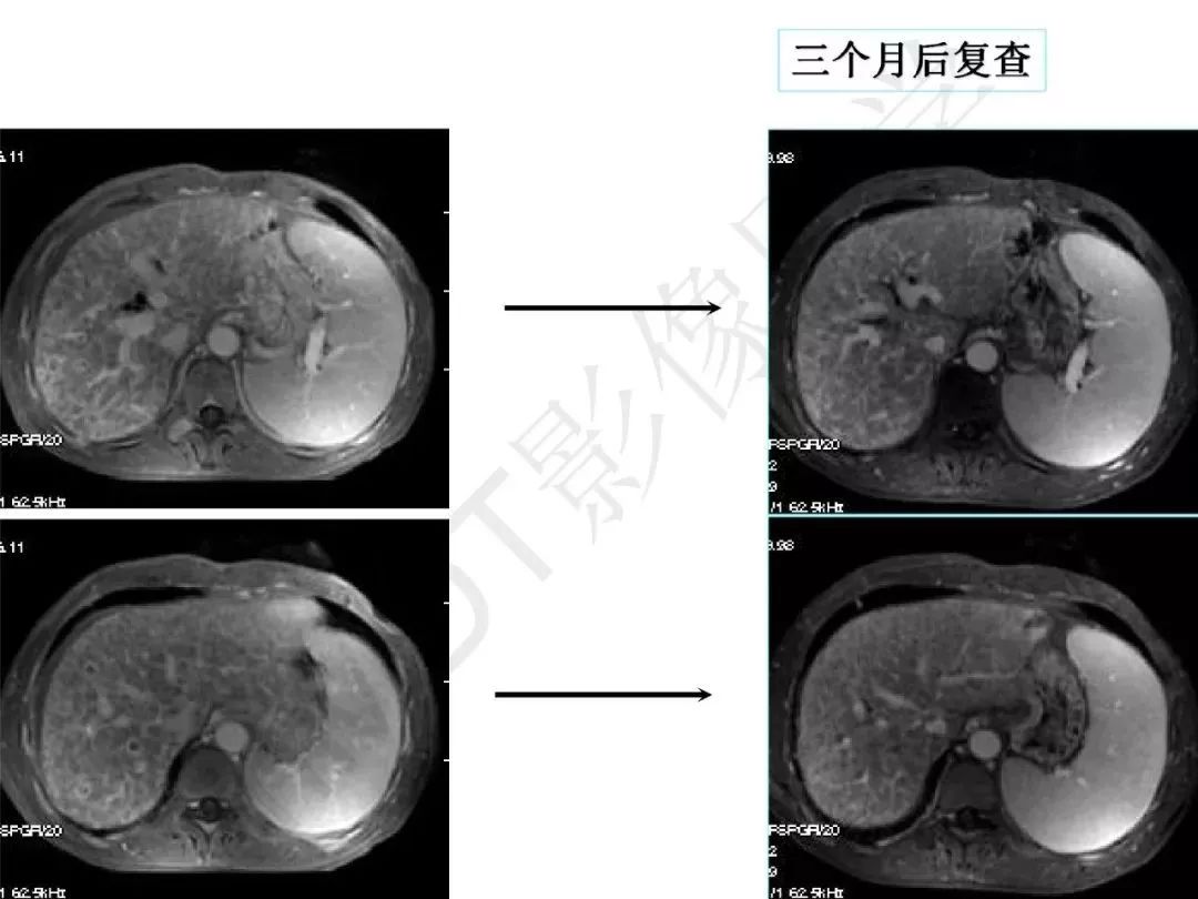 【PPT】纤维组织在肝脏炎性病变MR诊断中的价值