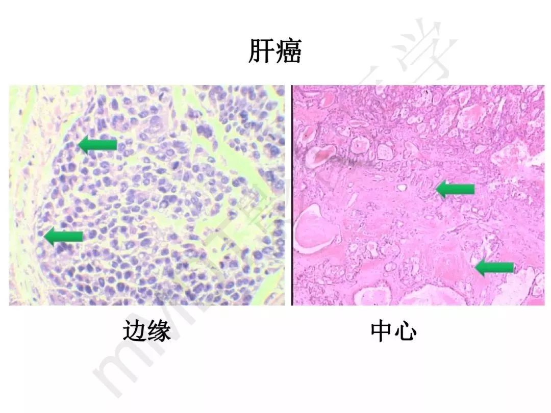 【PPT】纤维组织在肝脏炎性病变MR诊断中的价值