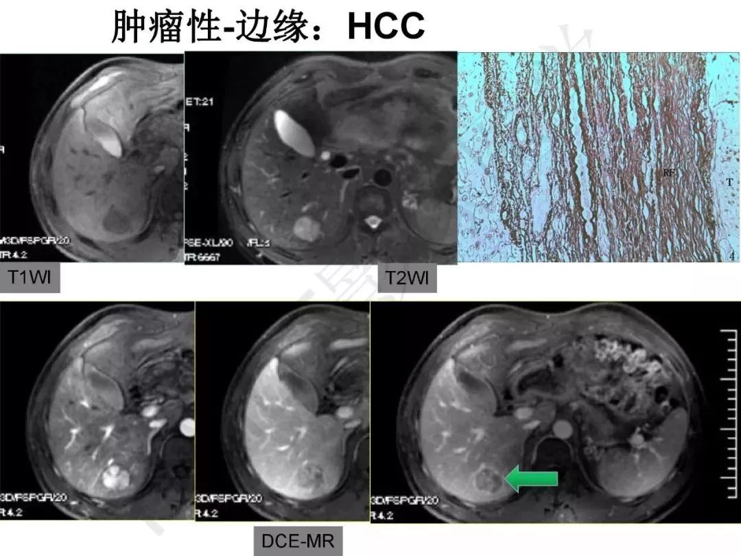 【PPT】纤维组织在肝脏炎性病变MR诊断中的价值