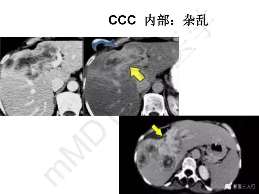 【PPT】纤维组织在肝脏炎性病变MR诊断中的价值