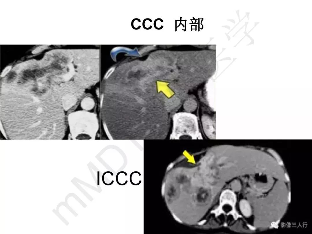 【PPT】纤维组织在肝脏炎性病变MR诊断中的价值