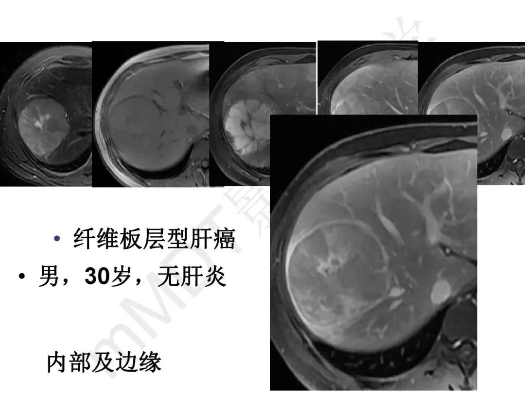 【PPT】纤维组织在肝脏炎性病变MR诊断中的价值