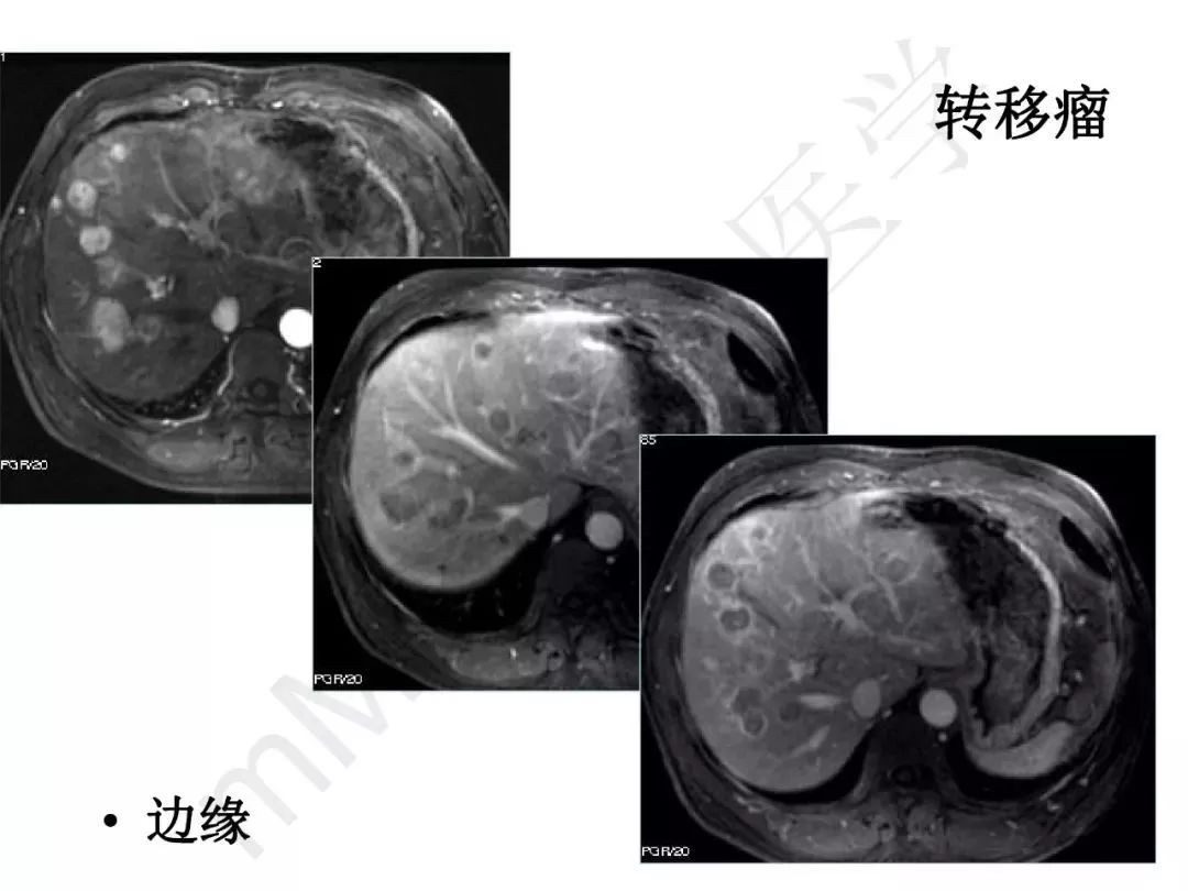 【PPT】纤维组织在肝脏炎性病变MR诊断中的价值
