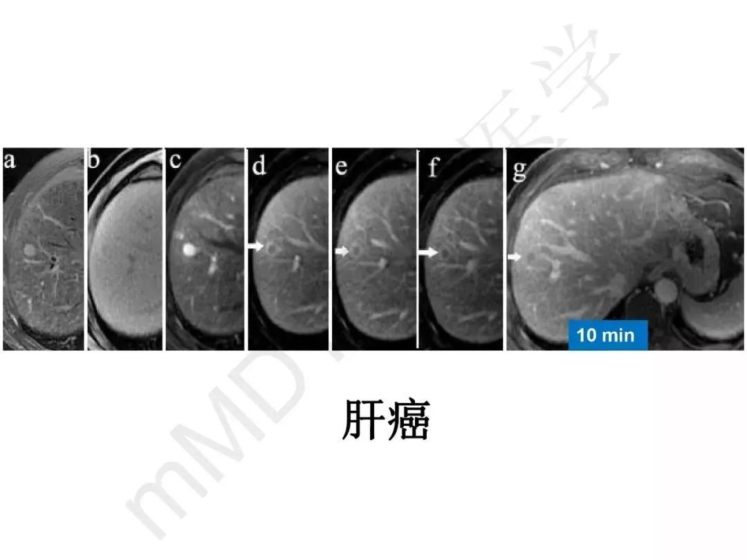 【PPT】纤维组织在肝脏炎性病变MR诊断中的价值
