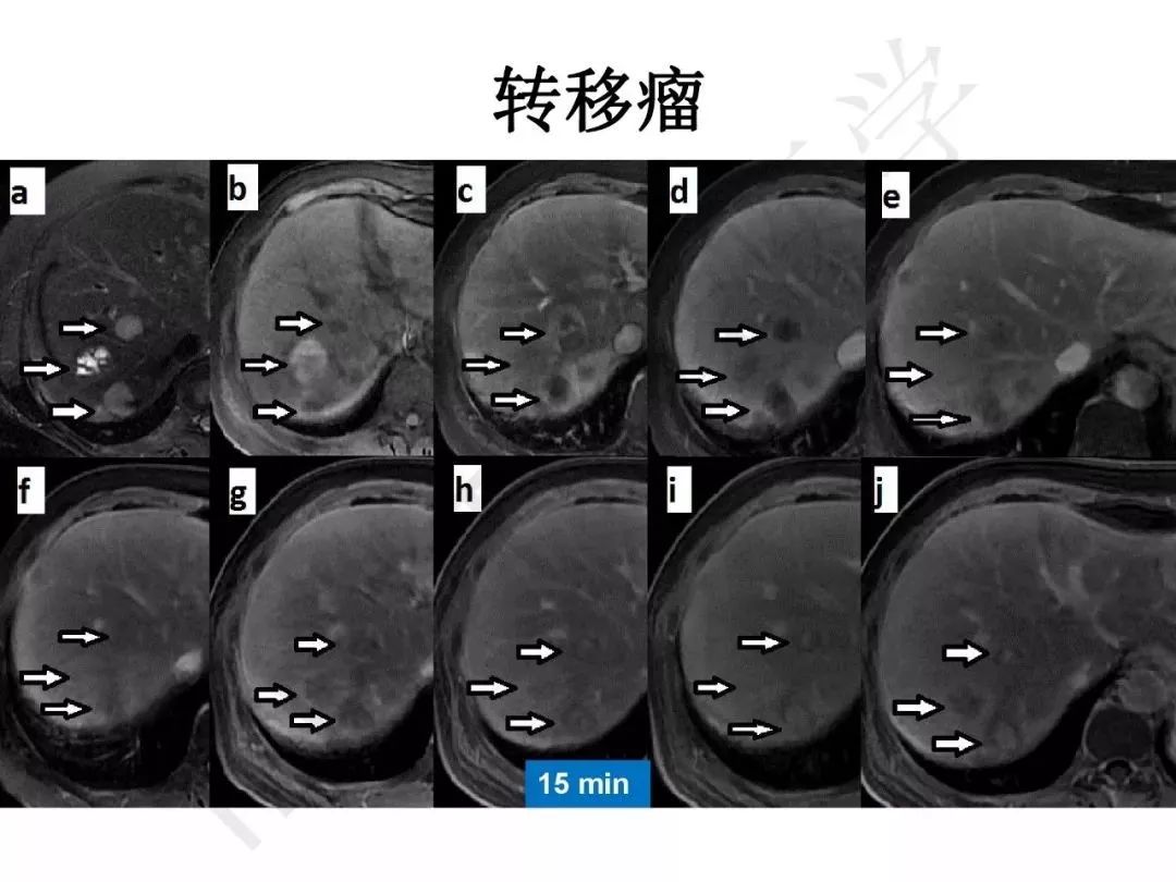 【PPT】纤维组织在肝脏炎性病变MR诊断中的价值