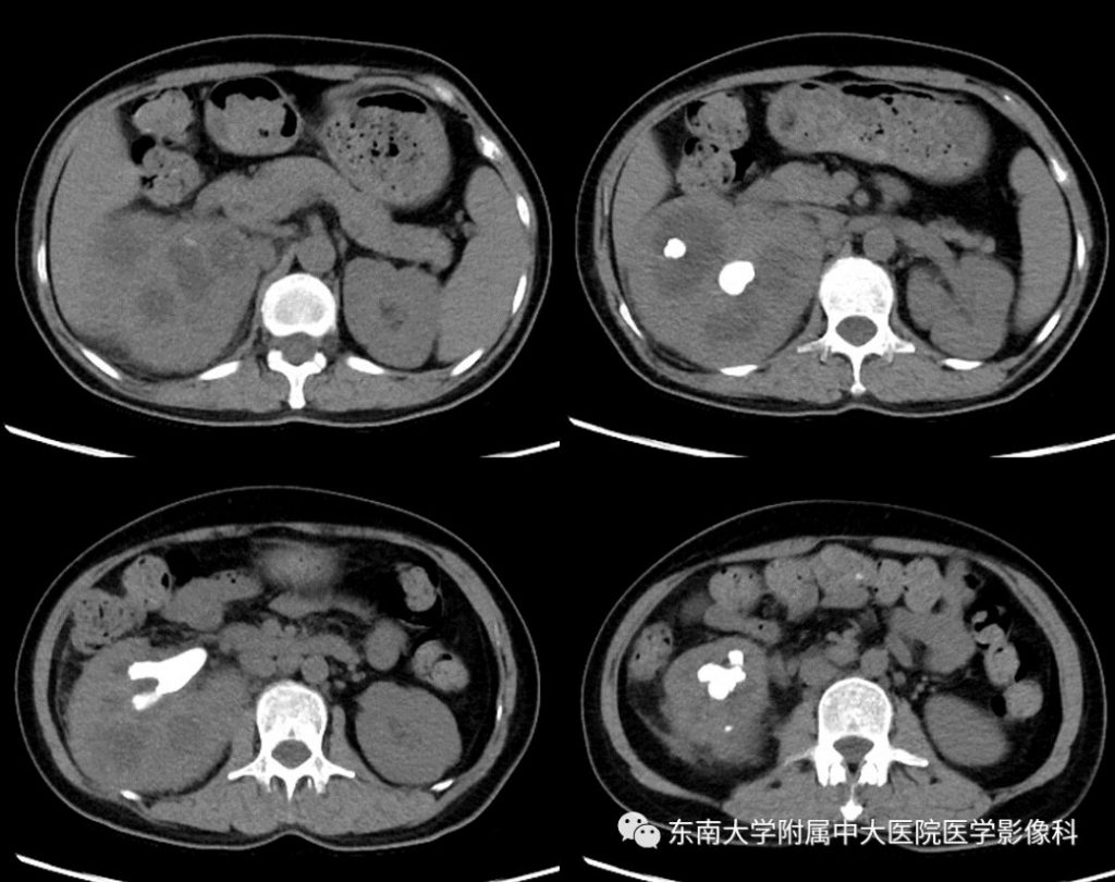 【病例】黄色肉芽肿性肾盂肾炎1例CT影像