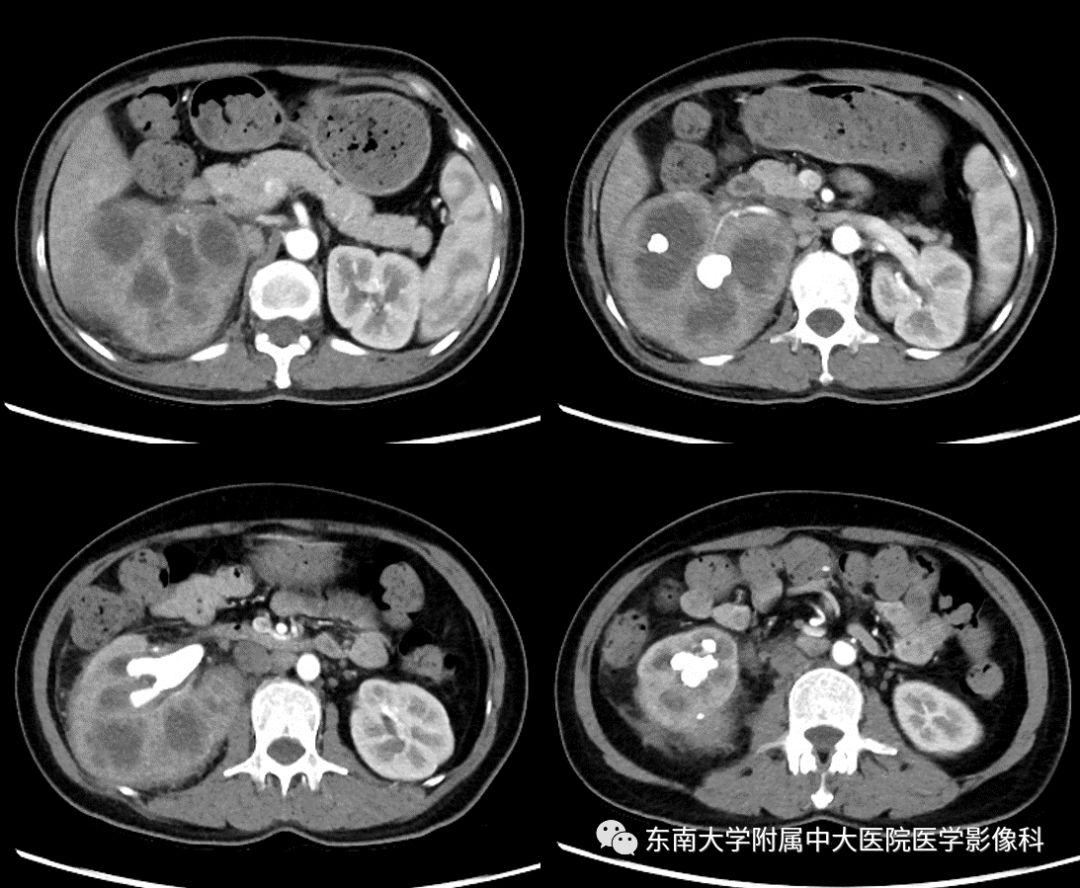 【病例】黄色肉芽肿性肾盂肾炎1例CT影像
