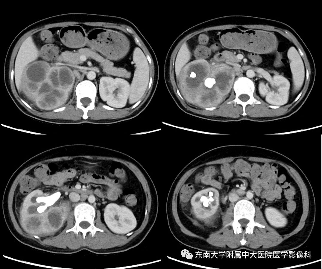 【病例】黄色肉芽肿性肾盂肾炎1例CT影像