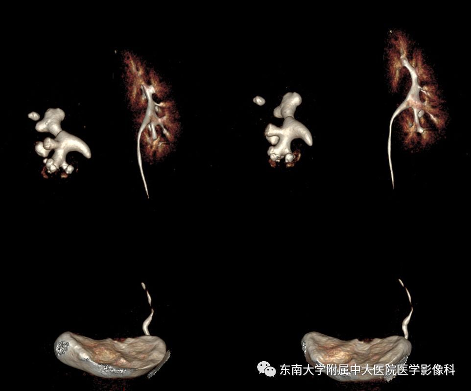 【病例】黄色肉芽肿性肾盂肾炎1例CT影像