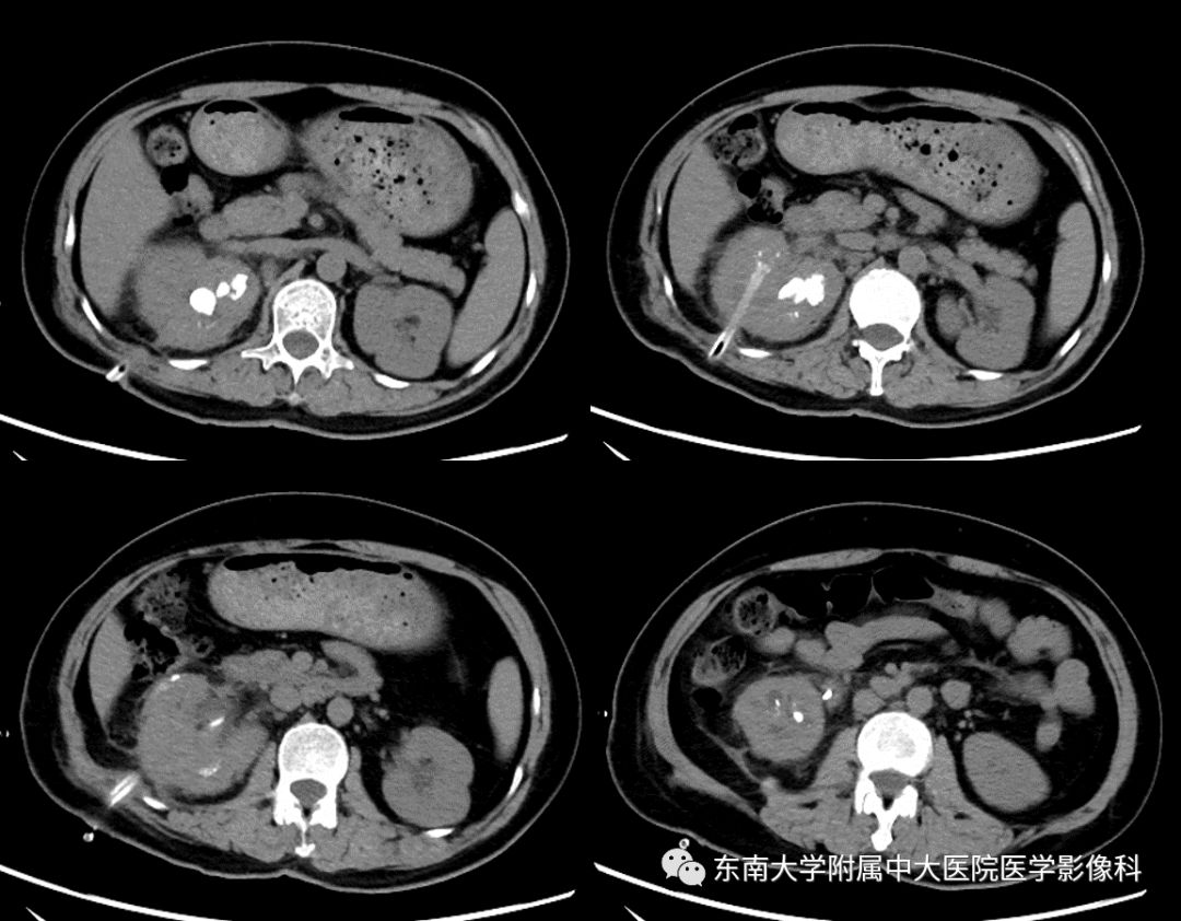 【病例】黄色肉芽肿性肾盂肾炎1例CT影像
