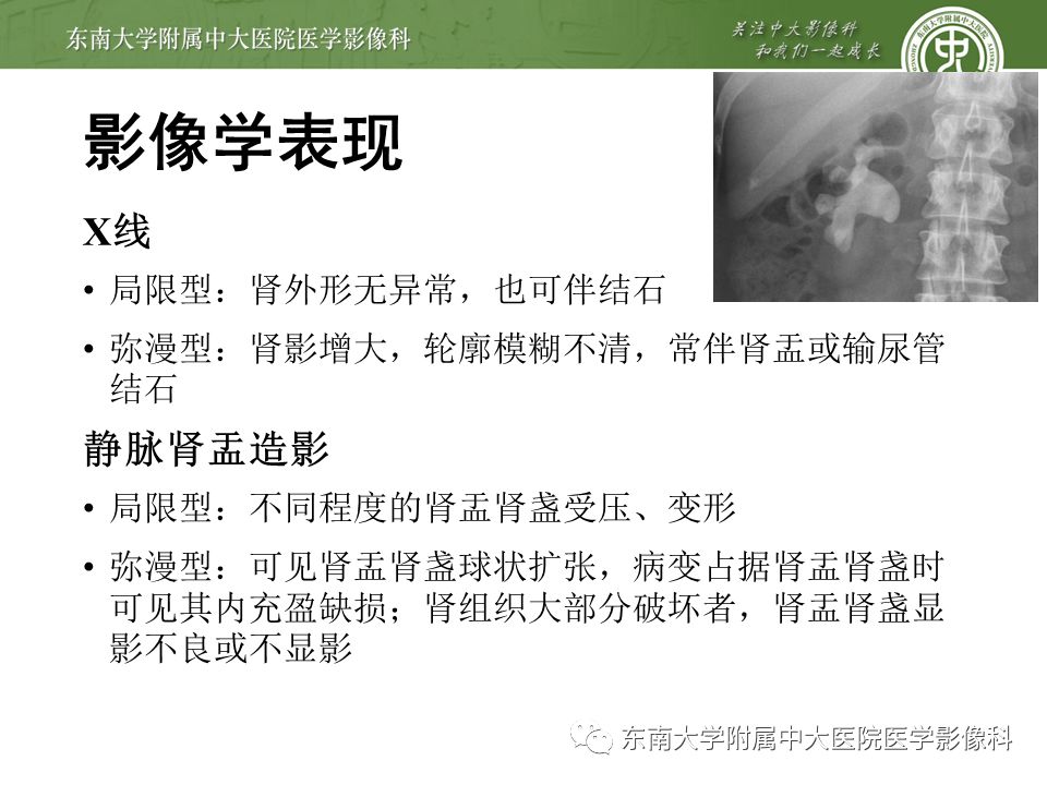 【病例】黄色肉芽肿性肾盂肾炎1例CT影像
