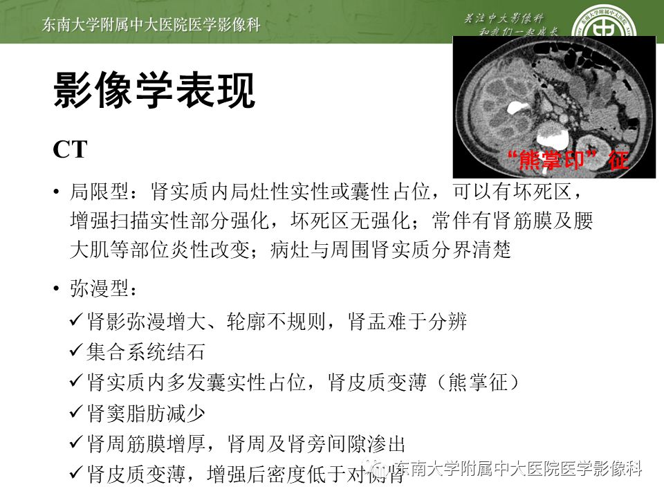 【病例】黄色肉芽肿性肾盂肾炎1例CT影像