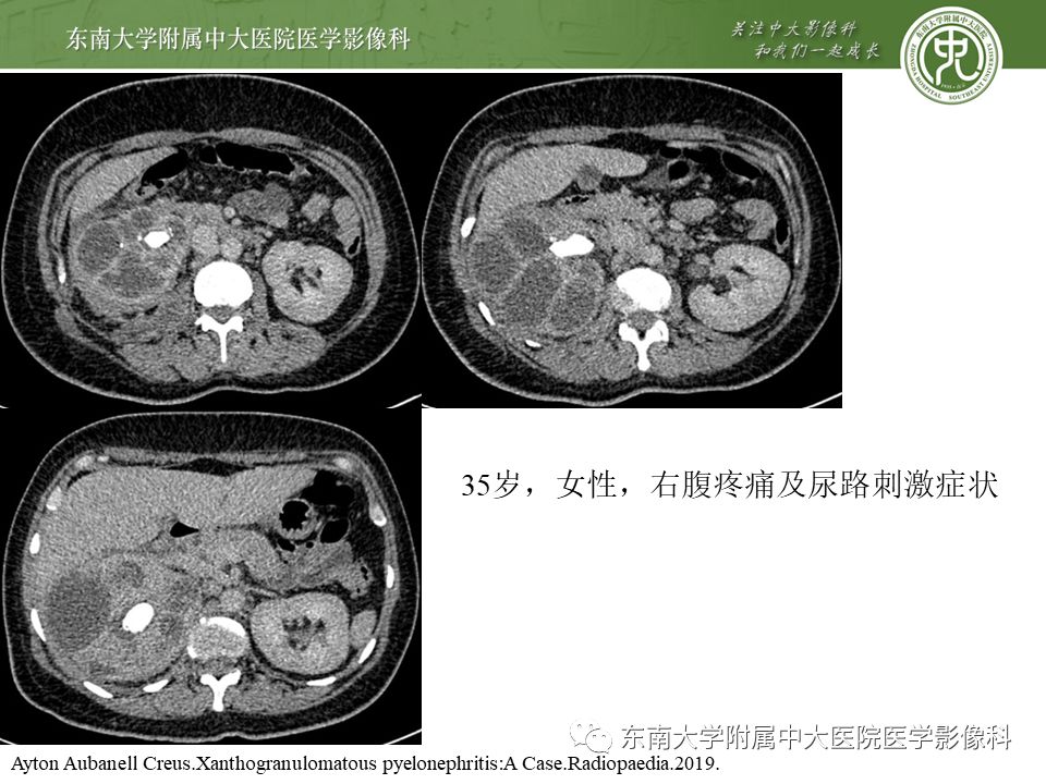 【病例】黄色肉芽肿性肾盂肾炎1例CT影像
