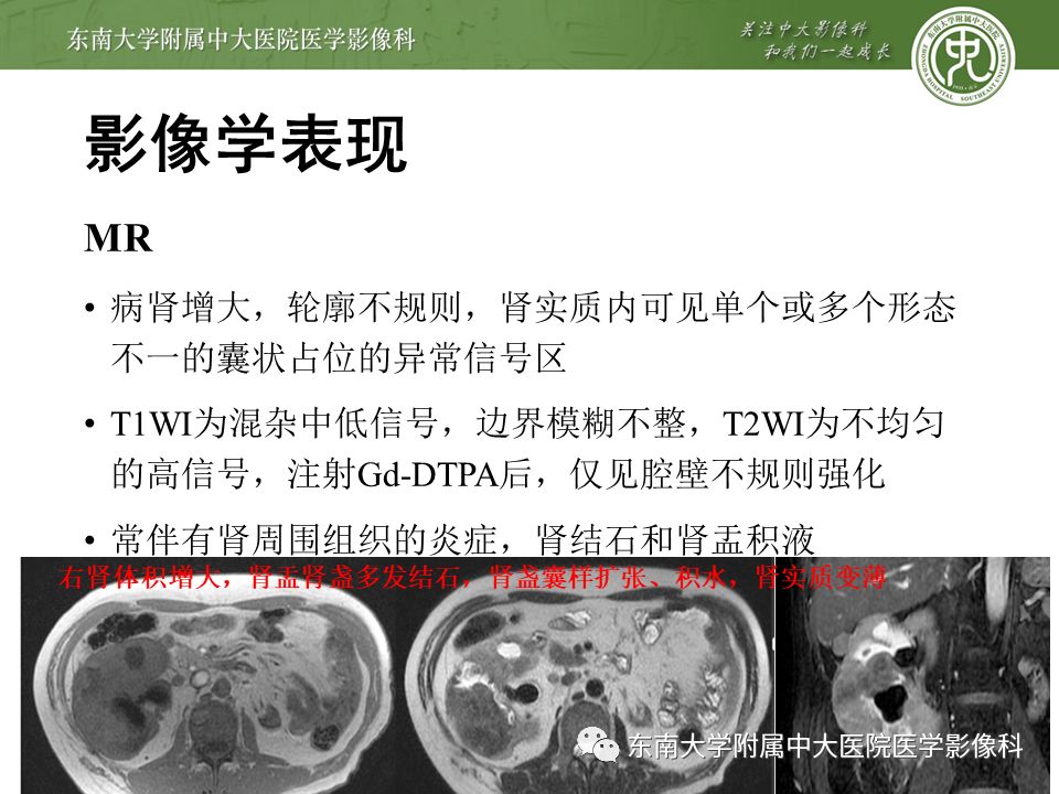 【病例】黄色肉芽肿性肾盂肾炎1例CT影像
